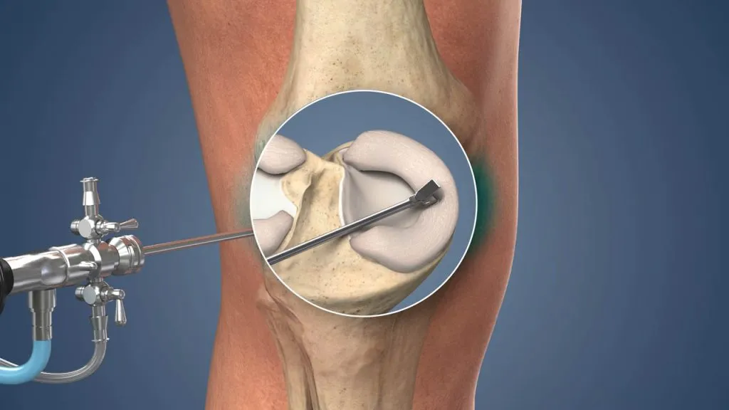 Arthroscopy Procedure SCC Greenville